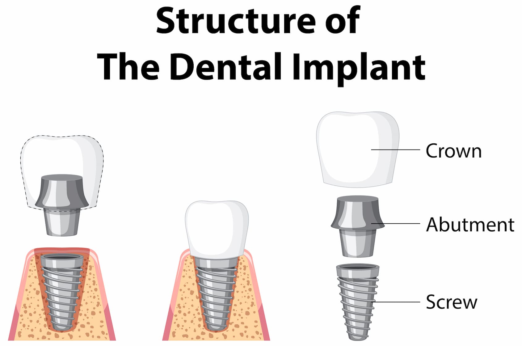 Structure of dental implant and how different components can be 3D printed